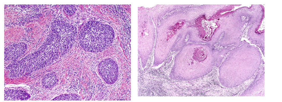 carcinom tế bào gai dạng đáy