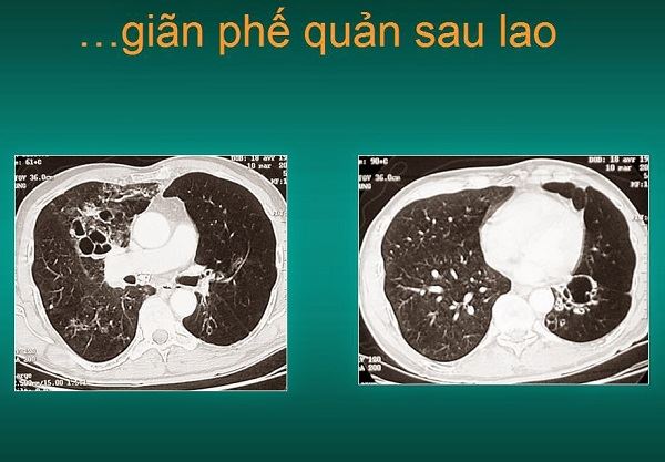 nguyên nhân giãn phế quản mạn tính