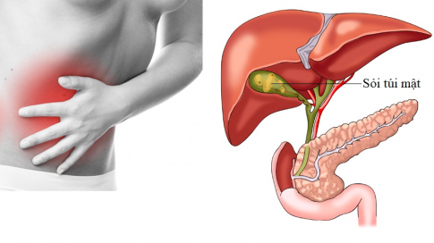 sỏi túi mật