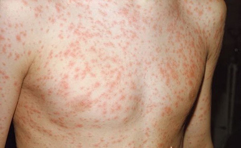 rubella