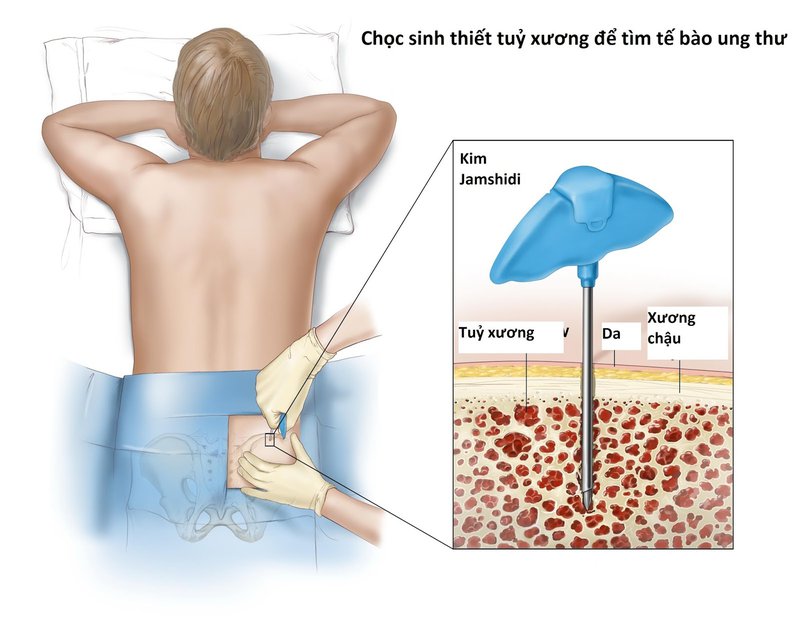 sinh thiết tủy xương