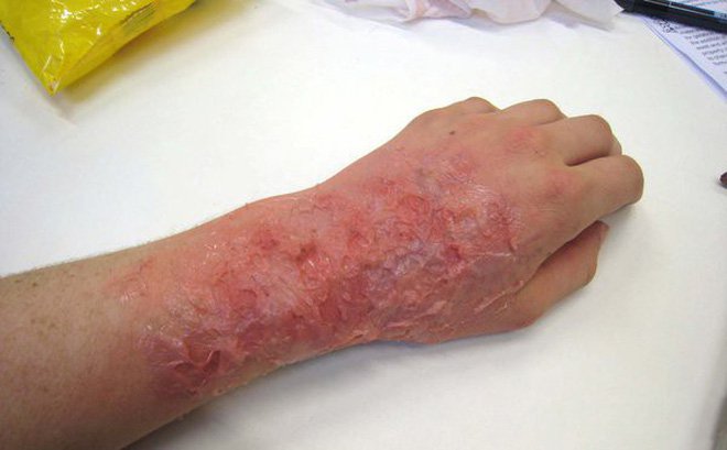 các giai đoạn của bỏng