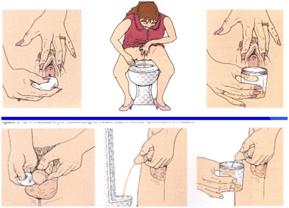 các-lấy-mẫu-nước-tiểu