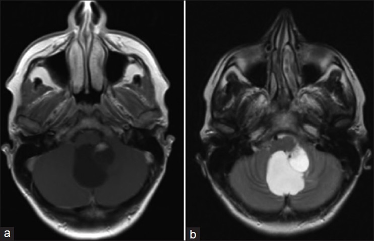 Hemangioblastoma