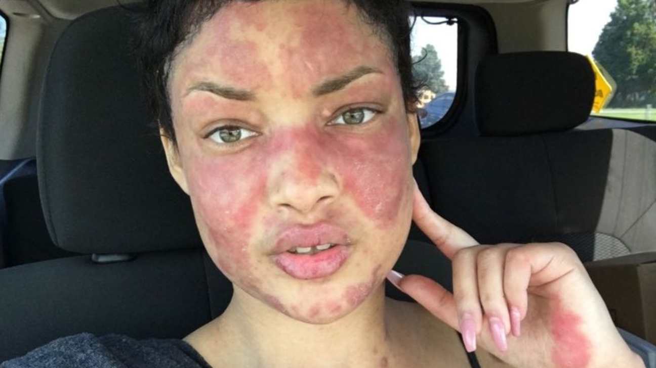 Lupus ban đỏ