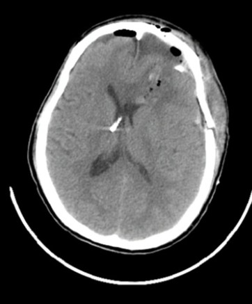 kiểm tra CTscan sau phẫu thuật