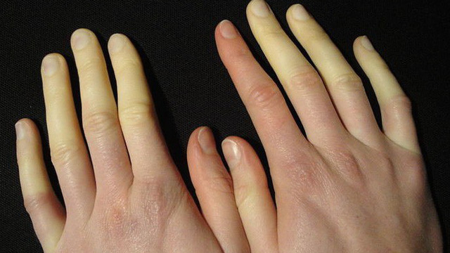 Hội chứng Raynaud