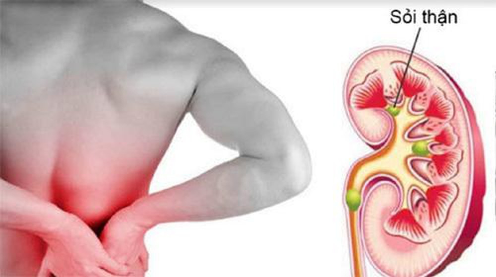 điều trị sỏi thận