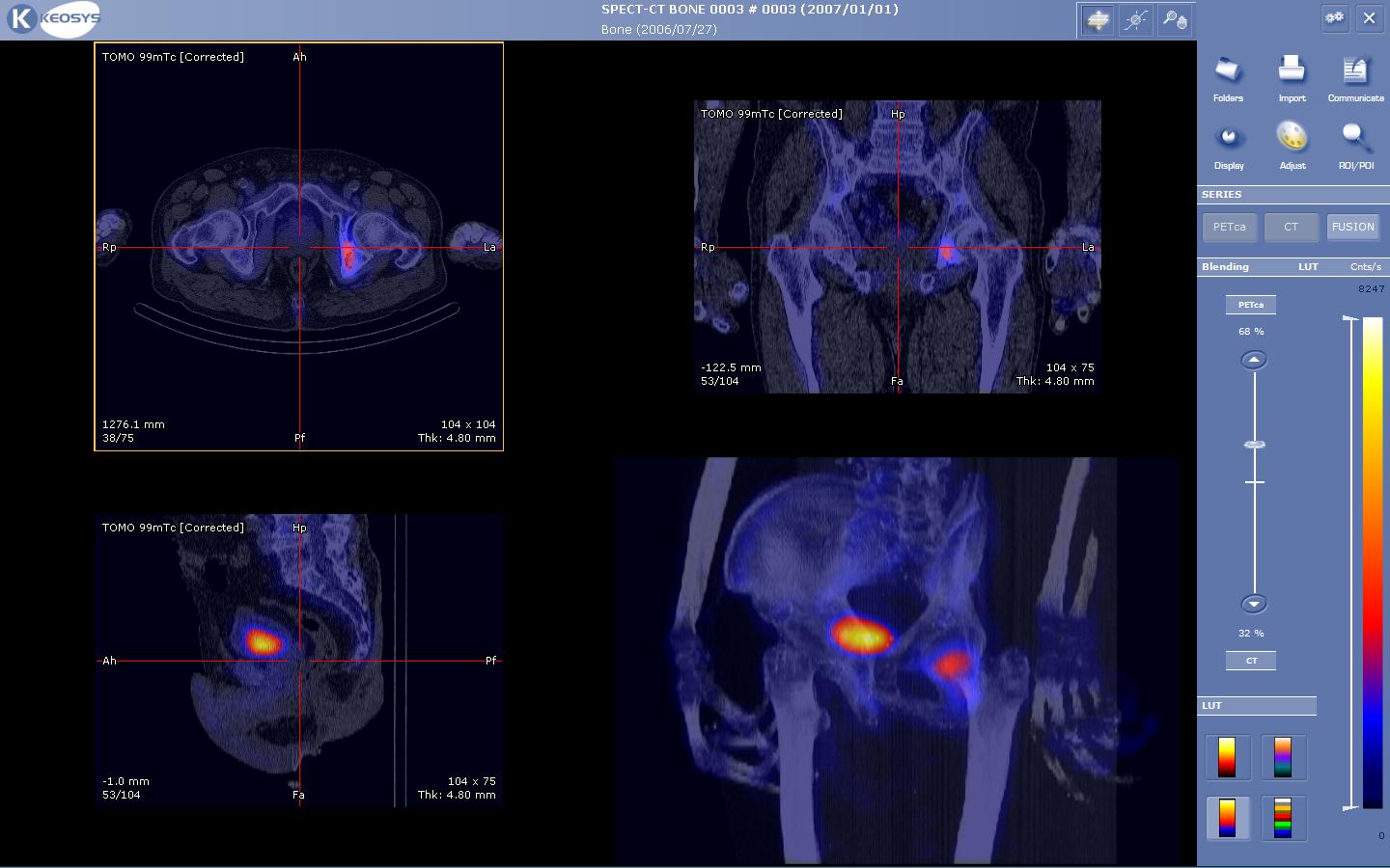 Hình ảnh Spect CT