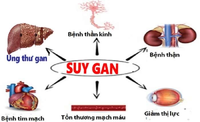 suy gan cấp