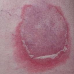 Bọng nước Pemphigoid
