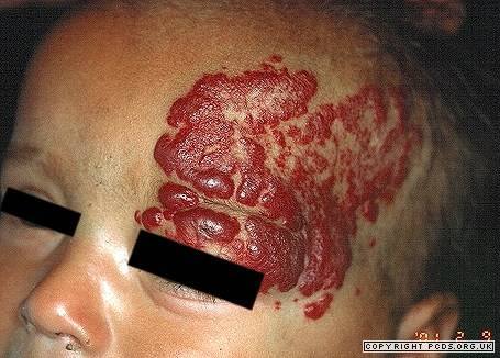 Điều trị bướu máu