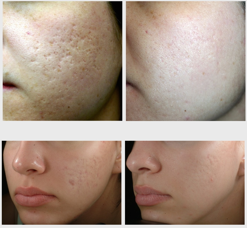 Điều trị sẹo mụn bằng laser