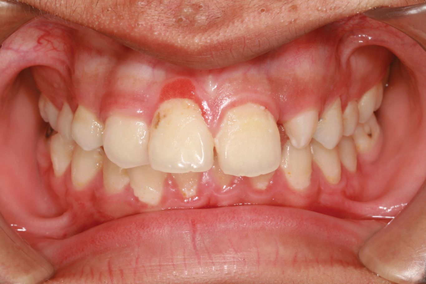 điều trị viêm lợi