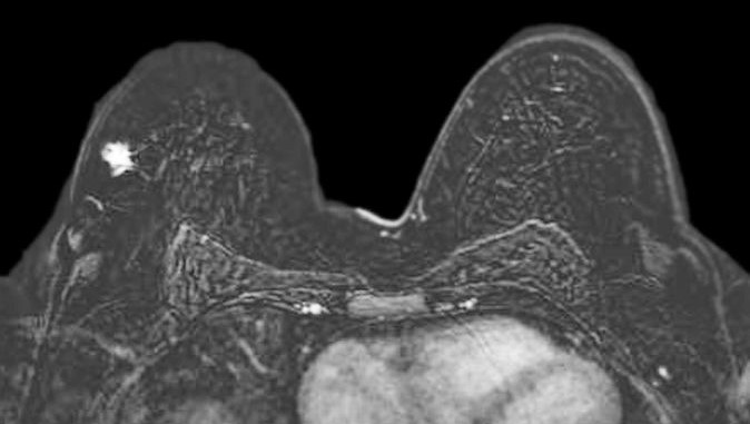 phim MRI tuyến vú