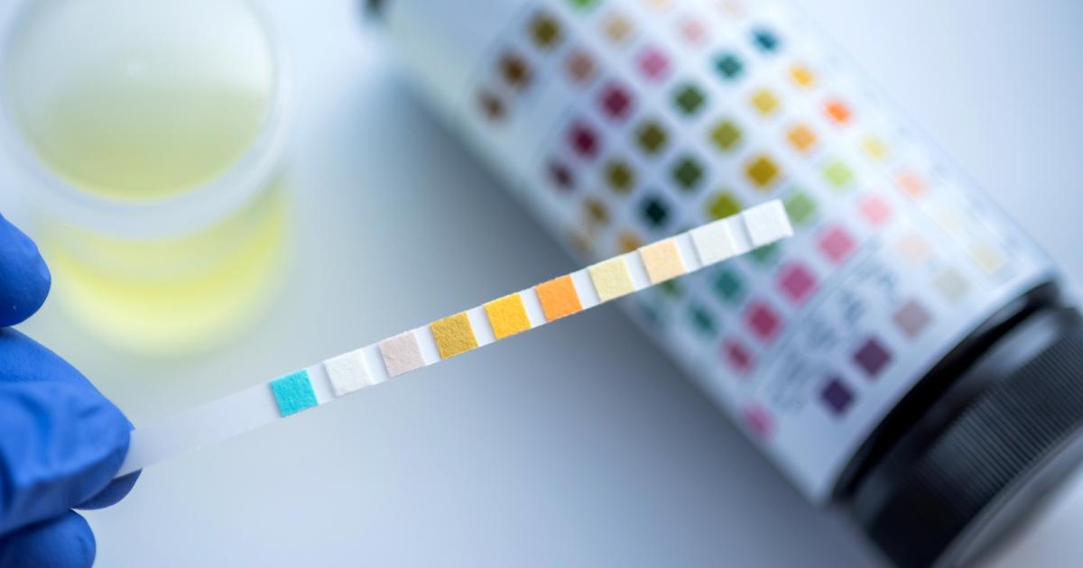 kiểm tra albumin nước tiểu