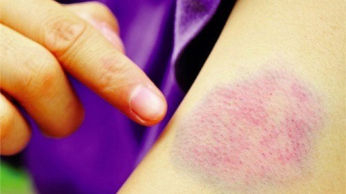 tình trạng giảm tiểu cầu