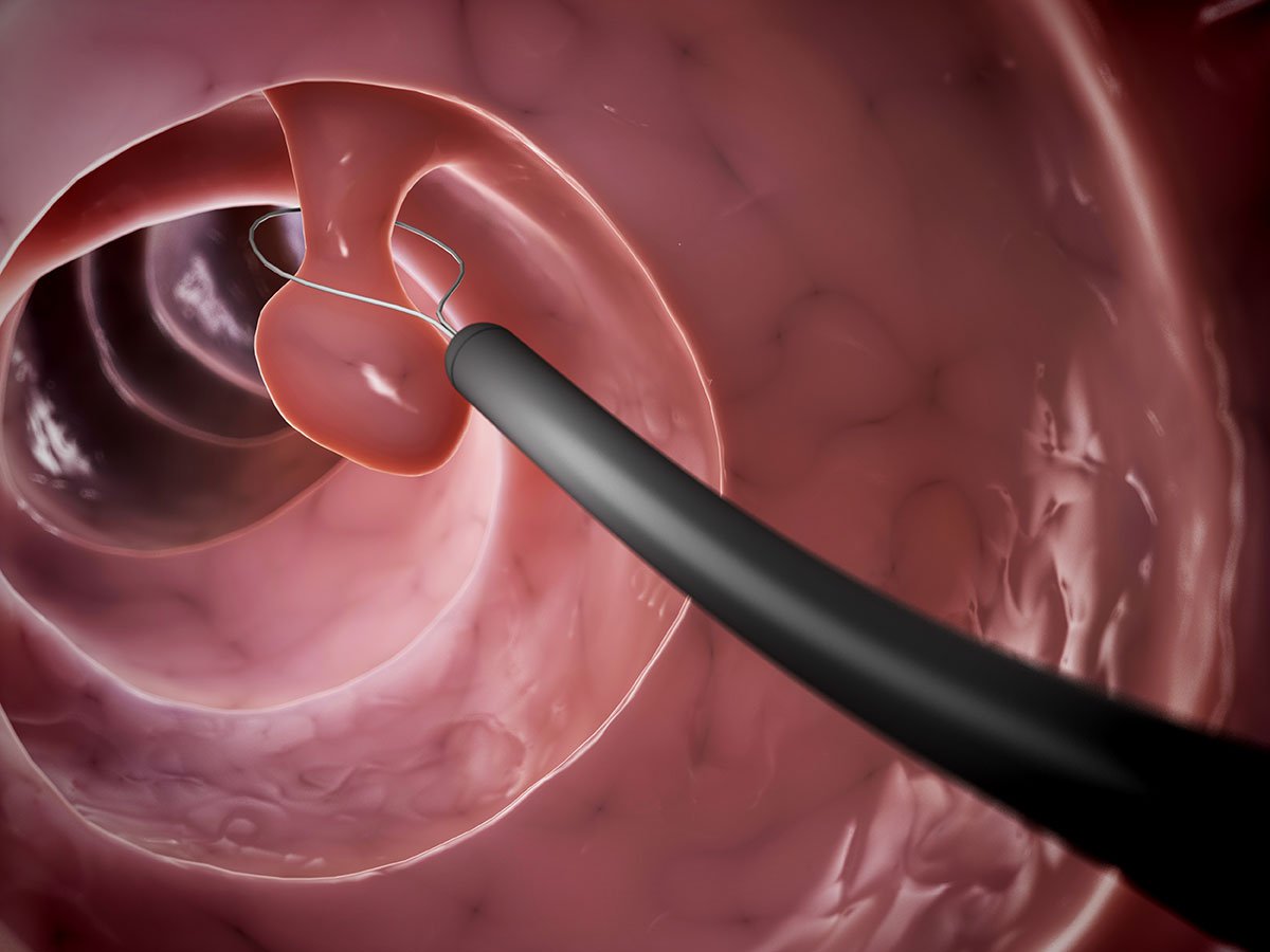 điều trị polyp đại tràng