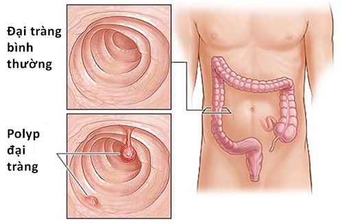 polyp đại tràng