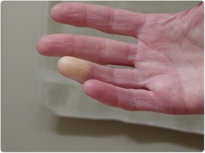 hội chứng raynauh