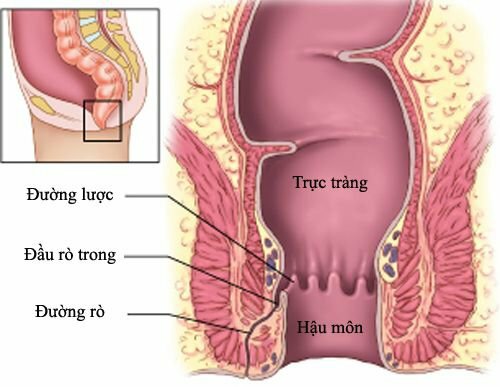 Triệu chứng của rò hậu môn