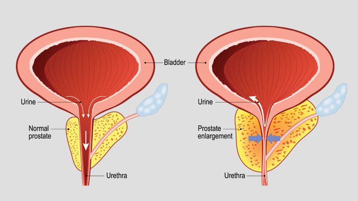 tăng sản tiền liệt tuyến lành tính