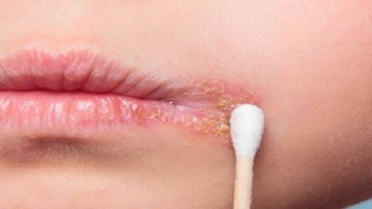 điều trị vết loét lạnh