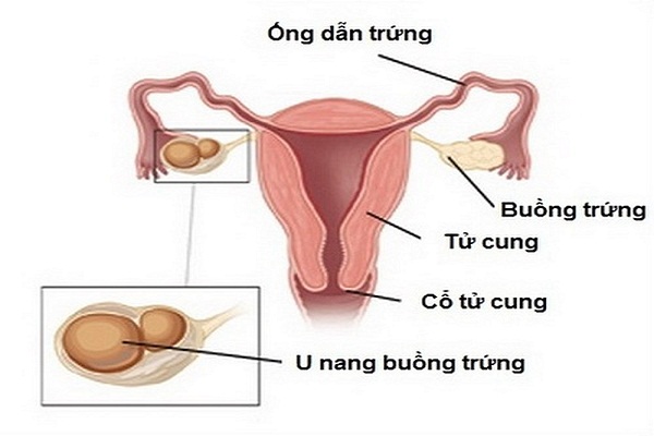 nang buồng trứng