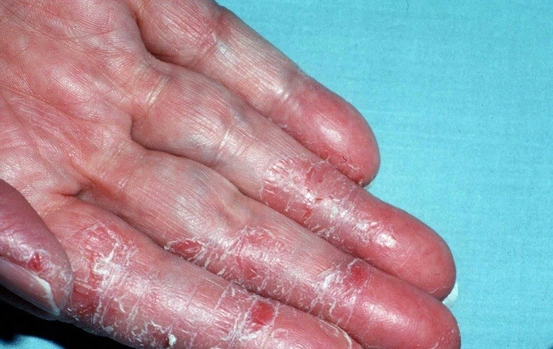 Triệu chứng của á sừng