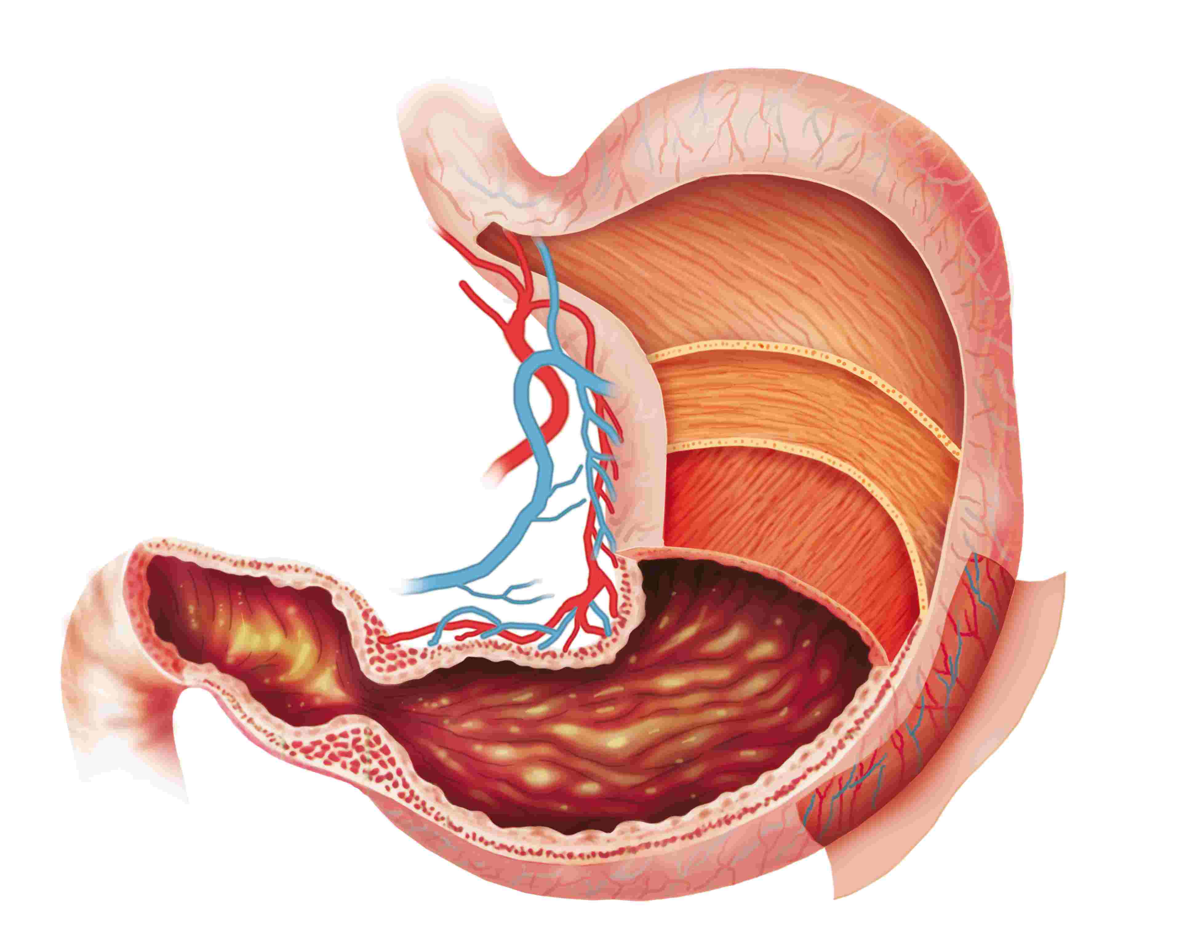 viêm dạ dày cấp