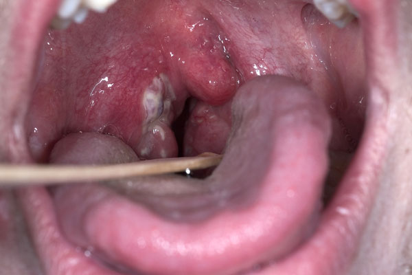viêm họng mủ ở trẻ em